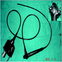 SAFE-3000 autofluorescence videobronchoscope. This system allows bronchial visualization by white light and autofluorescence separately (B) and by ‘Twin Mode’ and ‘MIX’ technologies (C). A, up and down; D, picture capture; E, aspirator. MIX, Multiple Image Xposition.