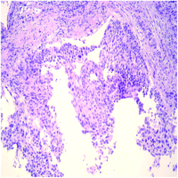 Squamous cell carcinoma. The diagnosis of malignancy is based on cell atypia and invasiveness.