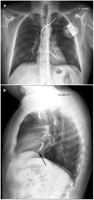 Apical (a) and lateral (b) chest X-ray showing ICD lead pointing posterior towards the left ventricular cavity (arrow). ICD, implantable cardio- verter defibrillator.
