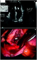 TEE: lead in left ventricle through the patent foramen ovale and the mitral valve (a), video-endoscopic: lead through the patent foramen ovale (b). TEE, transesophageal echocardiography.