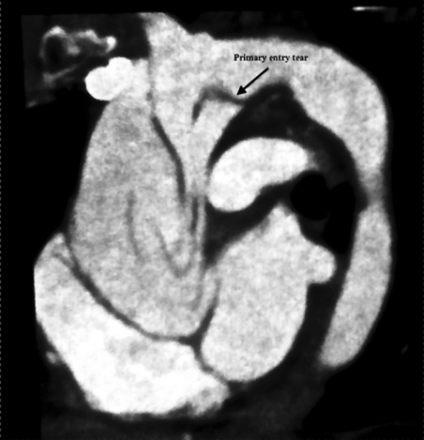 CT scan shows aortic dissection with a primary entry tear located in the concavity of the arch.