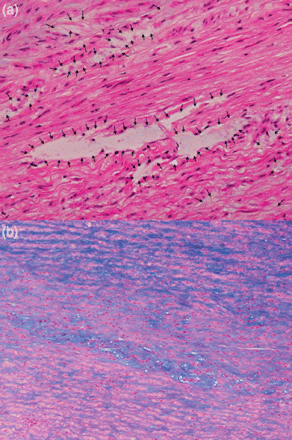 (a) Cystic medial necrosis (black arrows) without any fragmentation or separation of elastic fibres. (haematoxylin and eosin staining; original magnification ×200). (b) Intense mucoid degeneration (blue areas) located in the medial layer (Alcian blue staining; original magnification ×100).