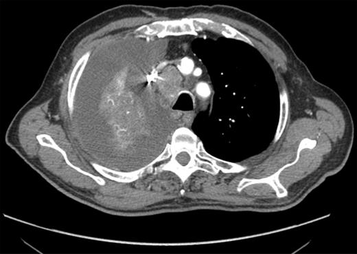CT-scan findings: a moderate right PE, associated with large and necrotic mediastinal lymph nodes, was detected and EUS-FNA indicated.