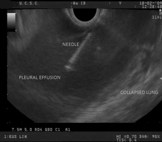 EUS findings: the right PE was easily sampled with a 22-gauge needle, without complications.
