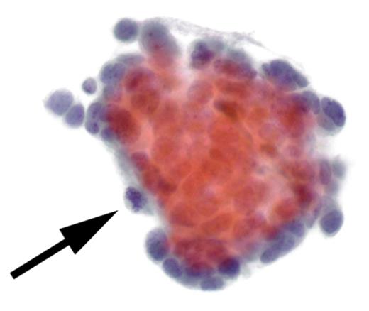 Cytological findings: the examination of the pleural fluid demonstrated the presence of malignant neoplastic cells (see arrow).