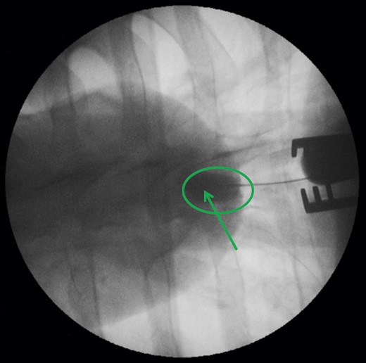 Angiographic view of the deployed TA PLUG after contrast medium injection into the device within the green circle. The green arrow points at the ventricular contrast markers of the device.
