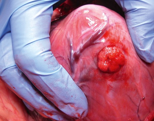 Intraoperative view of the pig heart. The TA PLUG device is precisely deployed and fully expanded within the myocardial wall of the left ventricle.