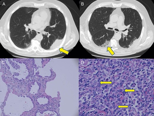 (A) Chest CT demonstrates a 7.2 cm left lower lobe pleural based mass with direct extension into the seventh rib denoted (arrow). (B) Chest CT image of the biopsy-proven adenocarcinoma arising in the right lower lobe denoted (arrow). (C) Haematoxylin and eosin staining of right lower lobe biopsy demonstrates a distinct lepidic pattern of malignant growth confirming adenocarcinoma. (D) Haematoxylin and eosin staining of left lower lobe pleural based tumour demonstrates epithelioid cells with vesicular nuclei and prominent nucleoli denoted (arrows). Numerous neutrophils are admixed with the tumour cells.