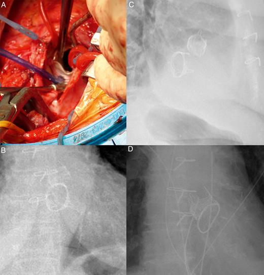 (A) Surgical view of the Intuity™ aortic valve (Edwards Lifesciences, Irvine, CA, USA) implanted after mitral valve replacement with a 29-mm Edwards Perimount™ valve (Edwards Lifesciences). (B and C) Thorax radiograms showing the simultaneous implant of the Intuity™ valve and the Perimount™ mitral valve. (D) A thorax radiogram showing the simultaneous implant of the Intuity™ valve and the Physio™ II mitral ring.