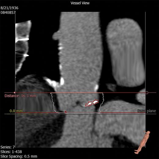 Stretched vessel view on the 3mensio Valves software showing the LV outflow tract, aortic valve, coronary arteries and ascending aorta. Superior and inferior borders of calcium measurement have been selected. Calcification is seen as highlighted.