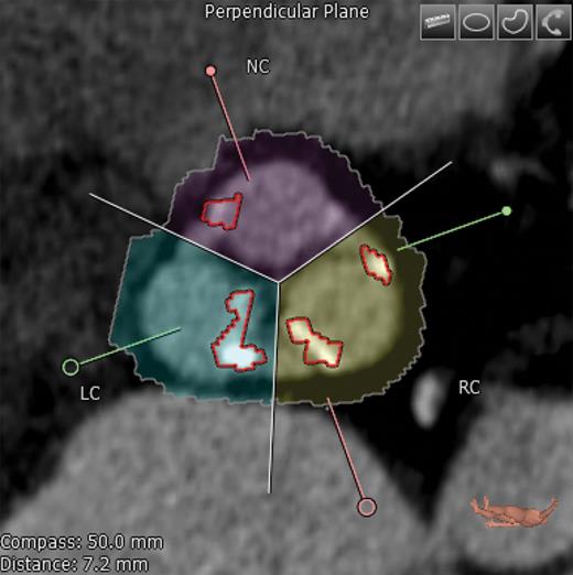 Transverse axis view showing the native aortic valve and cusps. Correct commissure locations have been determined and calcium deposition is shown highlighted here. NC: non-coronary; RC: right coronary; LC: left coronary.