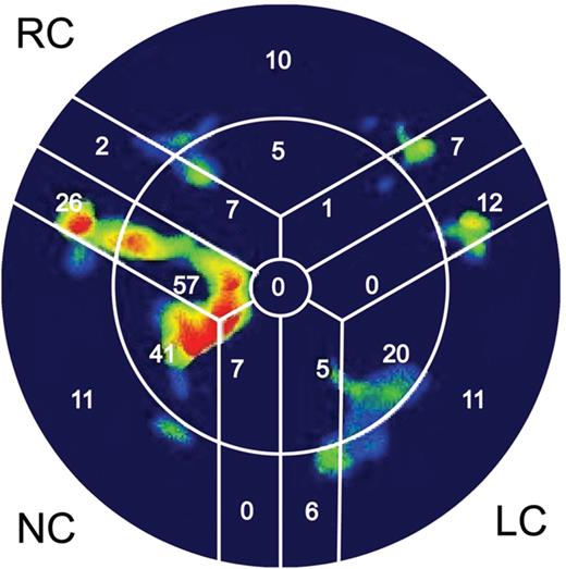 The ‘bull's eye’ representation, which schematically summarizes the amount of calcium deposition in corresponding cusps. Red and yellow colours represent large amounts of calcium. In dark areas, no calcium was detected. NC: non-coronary; RC: right coronary; LC: left coronary.