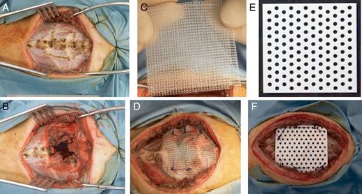 A mid-sternal vertical incision was made in a supine position and bilateral pectoralis major muscle flaps were made and retracted laterally (A). The 3-cm long sternal body along with a pair of rib cartilages was resected with full thickness (B). Using 5× 5 cm dual polypropylene mesh (C), the bony defect was reconstructed with No. 1 interrupted polypropylene stitches in the control group (D). Using 5 cm × 5 cm × 0.7 mm, rigid and bioabsorbable mesh material composed of poly-L-lactide acid (60 wt%) and uncalcined and unsintered hydroxyapatite (40 wt%) (E), the defect was reconstructed with No. 1 interrupted polydioxanone stitches in the experimental group (F).