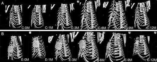 Representative three-dimensional images of the reconstructed anterior chest wall in the control group (A) and in the experimental group (B). The cephalad end of the lower remnant sternum tended to deviate dorsally in the control group. The rigid and bioabsorbable material in the experimental group appeared stable until 3 months, while it started to be degraded at 6 months. C: the control group; E: the experimental group; 0M: 0 month (immediately after reconstruction); 1–12M: 1–12 months postoperatively.
