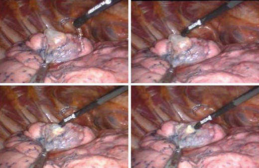 Transcollation technique: setting of perfusion, the tip in contact with the bulla, and coagulation of the bulla and around its base.