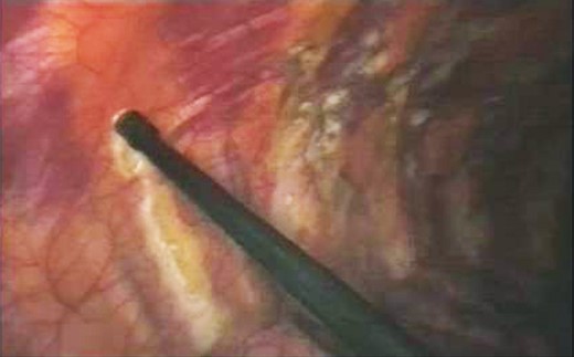 Pleurodesis procedure by hot coagulation (without perfusion) of the parietal pleura over the first eight costal arches.