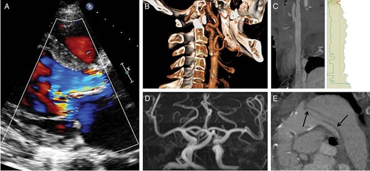 Anatomical characteristics of the first patient. (A) Parasternal long axis view obtained by Doppler TTE showing a wide regurgitation jet completely filling the LVOT during diastole; (B) three-dimensional reconstruction of the left carotid artery obtained by MSCT showing only mild calcification at the level of the bifurcation; (C) stretched reconstruction of the common carotid artery performed with the 3mensio software confirming sufficient diameter to accommodate the 18F sheath; (D) cerebral MR-angiography demonstrating patency of the circle of Willis. (E) MSCT sagittal view showing the residual dissection membrane (arrows) following type A aortic dissection involving the origin of the left subclavian artery and the descending aorta. The stentless Shelhigh conduit is moderately calcified. MSCT: multislice computed tomography.