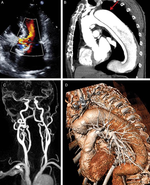 Vascular anatomy of the second patient. (A) Five-chamber view obtained by TTE showing moderate to severe aortic regurgitation; (B) MSCT-angiography enhancing residual findings following type A aortic dissection. The red arrow shows the localization of an aneurysm at the level of the distal conduit anastomosis; (C) MR-angiography of the supra-aortic vessels excluding relevant stenosis of the carotid arteries and confirming patency of the circle of Willis; (D) three-dimensional reconstruction of the thoracic aorta enhancing acute angulation between the conduit and the aortic arch rendering access via the left subclavian and left carotid arteries particularly hazardous.