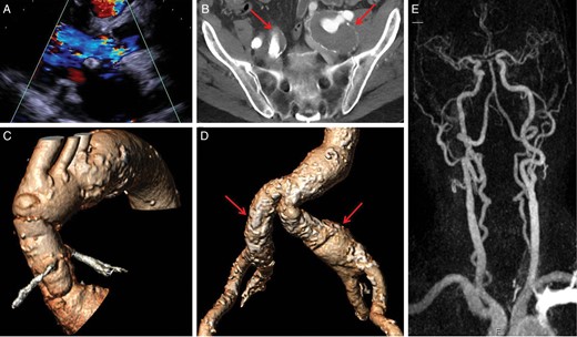 Summary of the pre-interventional diagnostic work-up of the third patient. (A) Parasternal long-axis enabling visualization of the relevant aortic regurgitation jet accompanied by beginning dilatation of the left ventricle; (B) transversal pelvic view (MSCT) showing dilatative arteriopathy of both iliac vessels. The arrows point thrombosed aneurysms of both common iliac arteries precluding transfemoral access; (C) three-dimensional reconstruction of the ascending aorta and the aortic arch enhancing unfavourable angulation of the left subclavian and carotid arteries. The right carotid offers the most direct access route; (D) three-dimensional reconstruction of the iliofemoral vascular axis showing bilateral involvement by dilatative arteriopathy; (E) MR-angiography of the supra-aortic vessels excluding stenoses of the carotid arteries and confirming patency of the circle of Willis.