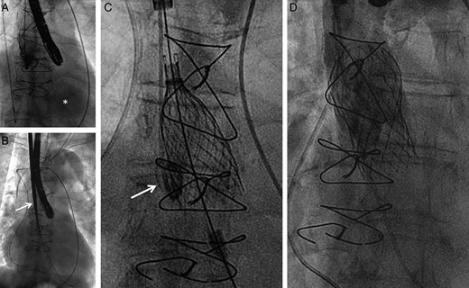 Implantation steps using patient two as an example. (A) Angiography of the ascending aorta with rapid opacification of the left ventricle (asterisk) confirming severe aortic regurgitation; (B) following surgical cut-down, introduction of the 18F sheath (arrow) via the right carotid artery; (C) deployment of the 29 mm Medtronic CoreValve using a pigtail placed in the right coronary cusp (arrow) as an anatomic marker of the annulus plane; (D) final angiography excluding relevant paravalvular regurgitation. Due to the limited diameter of the conduit (27 mm) the upper part of the nitinol frame was not fully deployed.