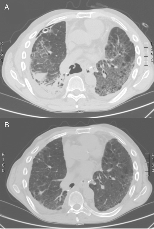 Chest CT scan: large bronchial suture dehiscence after right lower lobectomy and bilateral pneumonia (A). Control chest CT scan: bronchial stump's closure, sealed by diaphragm (B). CT: computed tomography.