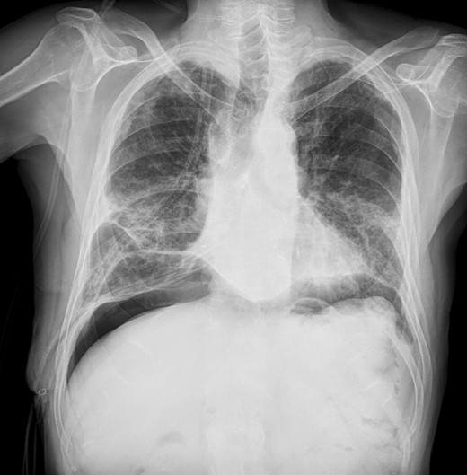 Chest X-ray after repeated pneumoperitoneum (roughly 1500 ml in two separate steps).