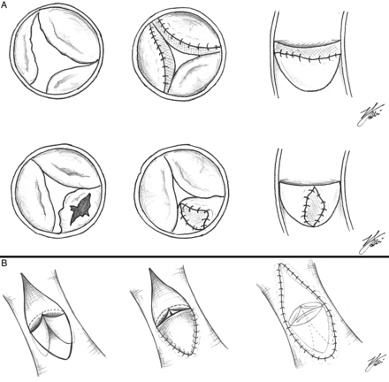 (A) Diagram showing the aortic valve repair technique: in the upper diagrams, the leaflet extension technique is described, in which usually the thickened and dysplastic leaflet edge is excised, or the leaflet is shaved, and the nodular lesions are excised. The length of the free edge of the leaflet is usually measured and the height of the leaflet extension is determined by measuring the depth of the native left coronary leaflet. Based on these two measurements, rectangular-shaped SIS–ECM extensions are sewn to the free edge of the cusps by 6.0 or 7.0 polypropylene sutures; the new commissures are then created by sewing each of the two leaflets of the aortic wall together upwards towards the new sinotubular junction. In the lower diagrams, leaflet augmentation is described, in which the leaflet surface (which is deficient congenitally or presents a perforation) is augmented by the inclusion of a SIS–ECM patch inside the native tissue, which completely surrounds the SIS–ECM patch. (B) Diagram showing pulmonary valve reconstruction in a transannular repair of tetralogy of Fallot by means of the SIS–ECM patch applied as pulmonary valve anterior leaflet; then the right ventricular outflow tract and the main pulmonary artery are reconstructed by means of another larger SIS–ECM patch. SIS: small intestine submucosa; ECM: extracellular matrix.