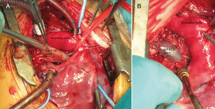 In an 8-month old patients with a single ventricle and hypoplastic right pulmonary artery (RPA), a SIS–ECM patch plasty is performed on the RPA: in (A), the RPA is incised longitudinally and the rectangular-shaped SIS–ECM patch is calibrated on a Hegar dilator whose diameter is adequate to the RPA of the patient; the SIS–ECM patch is sutured with 7.0 prolene on the RPA and the final result of SIS–ECM patch plasty is shown in (B). SIS: small intestine submucosa; ECM: extracellular matrix.