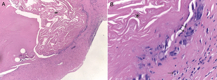 Dystrophic aortic valve leaflet reconstructed with SIS–ECM (Cormatrix) in a 16-year old female, with a diagnosis of congenital aortic stenosis (bicuspid), who had undergone aortic valve balloon dilatation at 5 days of life. This is a histological finding at reoperation (Ross operation) which occurred 24.4 months after aortic valve repair (leaflet extension), at 14 years of age. (A) Haematoxylin and eosin staining shows an intact SIS–ECM scaffold material inside the native leaflet valve tissue (asterisk), with no cell repopulation and no calcifications (×20 of magnification). (B) At greater magnification (×40 of magnification), in the same specimen, with intact SIS–ECM scaffold material inside the native leaflet valve tissue (asterisk), it is possible to visualize a weak inflammatory infiltrate in the valve leaflet–SIS–ECM scaffold transition area, characterized by lymphocytes (double arrows) and giant cells (single arrow). SIS: small intestine submucosa; ECM: extracellular matrix.