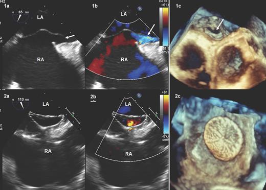 TOE before (1a, two-dimensional; 1b, colour-Doppler; 1c, three-dimensional) and 6 days after (2a, two-dimensional; 2b, colour-Doppler; 2c, three-dimensional) PFO closure with the Cribriform Amplatzer device. The white arrows show the PFO. LA: left atrium; PFO: patent foramen ovale; RA: right atrium; TOE: transoesophageal echocardiography.