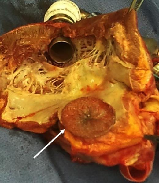 The primitive heart after orthotopic heart transplantation, showing the Amplatzer device.
