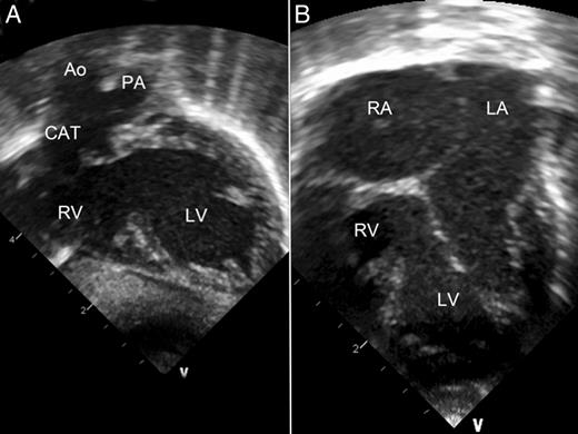 Preoperative 2D echocardiography. (A) Long-axis view. Hypoplastic RV and PA arising from the posterior aspect of the CAT. (B) Four-chamber view. Normal atrial arrangement is noted. Ao: aorta; CAT: common arterial trunk; LA: left atrium; LV: left ventricle; PA: pulmonary artery; RA: right atrium; RV: right ventricle.