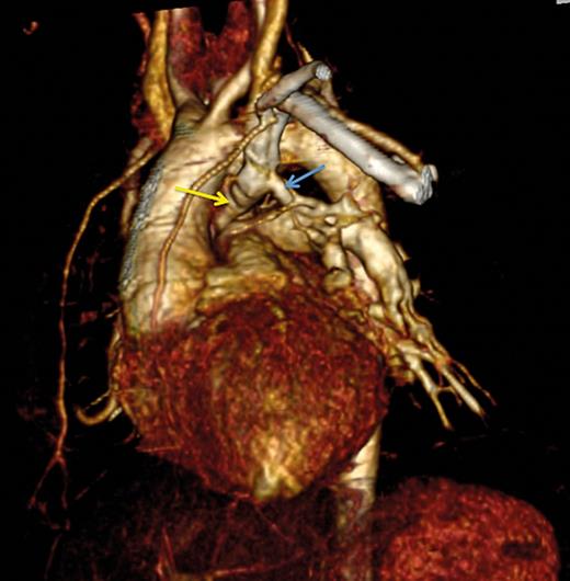 Three-dimensional computed tomography scan. The 3-mm left upper pulmonary vein (blue arrow) draining into the retro-aortic innominate vein (yellow arrow).