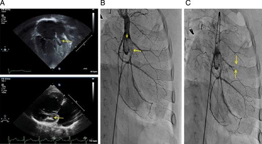 (A) Transthoracic echocardiography at presentation. Apical (top, performed in complete heart block) and parasternal-long (bottom, performed in normal sinus rhythm) views showing an enlarged right ventricle and a hypoplastic left ventricle, with an intracavitary thrombus measuring 3.5 × 9 mm (arrows). (B) Contrast injection above the native aortic root, performed in right anterior oblique angulation with caudal tilt. Large thrombotic mass is present in the aortic sinuses (arrowhead). Large thrombus is also observed in the proximal portion of the left circumflex artery (arrow). (C) Following bolus administration of thrombolytic therapy, a new cut-off of a diagonal artery was observed (arrows), likely due to an embolic event.