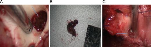 In situ (A, arrow) and post-removal (B) aortic root thrombus as observed at surgery. (C) Following thrombus removal, the aortic valve was over-sawn (arrow).
