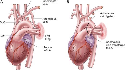 L-PAPVC before (A) and after (B) repair.