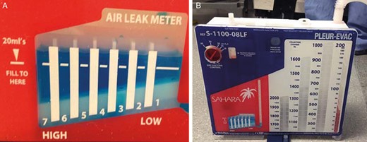 (A) Magnified view of a typical analogue air leak meter found on analogue pleural drainage systems. Air leak severity is determined by visually matching the train of air leak bubbles with the numbered columns (1+ to 7+); (B) Analogue pleural drainage system.