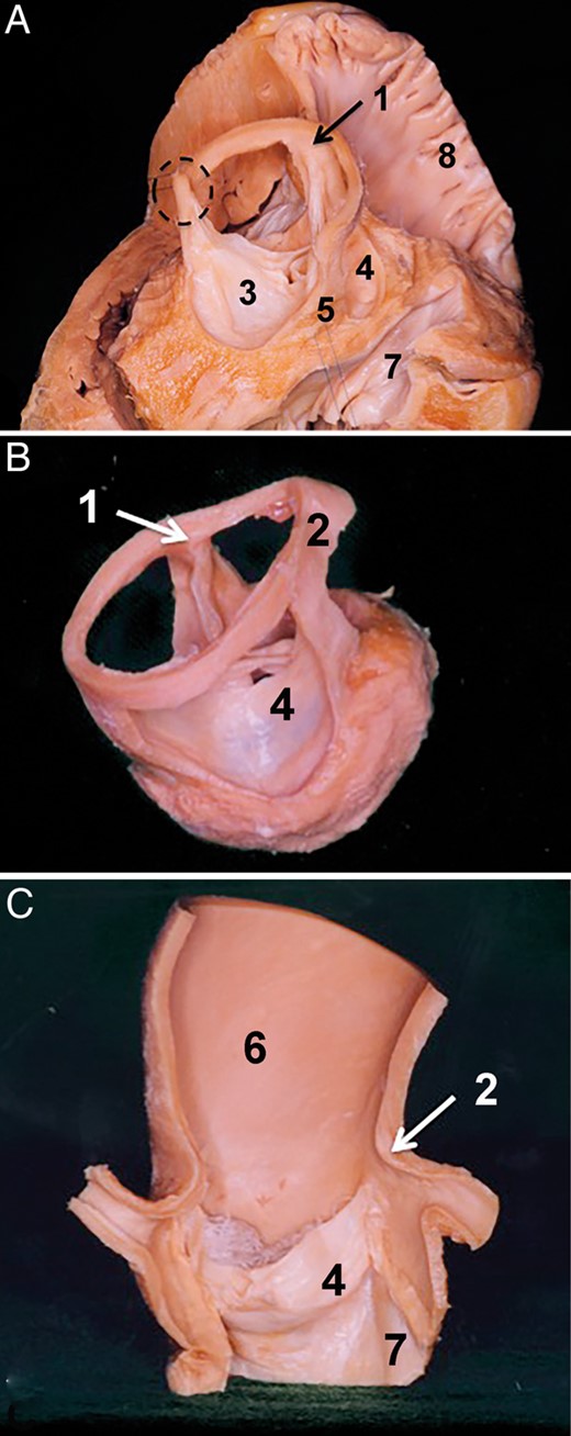 Sinotubular junction as the superior border of the aortic root. (A) Dry dissected aortic root in situ. The aortic root is seen from the superior right view. The right ventricle, right atrium as well the left atrium were removed. The wall of the three sinuses of Valsalva was also removed. The sinotubular junction is in situ over the non-coronary and the right coronary sinus; over the left coronary sinus it was removed. In this view, one can clearly see that the three commissures are at the level of the sinotubular junction. (B) Isolated aortic root where the three sinuses of Valsalva were removed. The sinotubular junction is in situ. One can again observe that the three commissures are at the same level as the sinotubular junction. (C) The vertical section of the ascending aorta and the aortic root. The section plane is positioned at the middle of the left and right coronary artery ostium. Leaflets of the right and left coronary sinus were removed. Specimens show that the sinotubular junction represents a transition between the sinuses of Valsalva and the tubular part of the ascending aorta. 1. Commissure over the right intervalvular triangle, 2. Sinotubular junction, 3. Left aortic valve leaflet, 4. Right aortic valve leaflet, 5. Posterior intervalvular triangle, 6. Ascending aorta, 7. Membranous septum and 8. Right atrium.