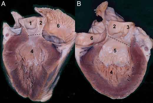 Aortic root base, inferior border to the aortic root. The section plane on the presented specimen runs through the left side of the non-coronary sinus. (A) In this specimen, the aortic root base is seen at the nadirs of the right and the non-coronary sinus. Note at this level that the aortic root base runs over the transition between the right intervalvular triangle and the membranous septum. The dashed line indicates the aortic root base at this level. Note that the transition between the membranous septum and the intervalvular triangle is continuous. (B) Right side of the specimen. The dashed line of the aortic root base over the mitral valve is presented. The leaflets of the non- and the left coronary sinus are left in place. Here, also the transition between the posterior intervalvular triangle and anterior mitral valve leaflet is seen. 1. Right coronary sinus, 2. Non-coronary sinus, 3. Left coronary sinus, 4. Left ventricle, 5. Anterior leaflet of the mitral valve and 6. Left atrium.