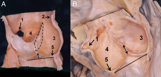 Morphology of the aortic valve coaptation. (A) Isolated aortic root is seen in the vertical plane. Section plane runs through the middle of the non-coronary sinus and the left intervalvular triangle. The coapatation between the right and non-coronary leaflets is seen. The coaptation between two leaflets is marked with a dashed line. Solid line at the aortic root base marks the plane of the aortic root base. The arrow indicates that the coaptation in a normally functioning aortic valve is beyond the aortic root base. (B) Coaptation of the leaflets as seen in the frontal view. The section plane of the aortic root is placed through the middle of the non-coronary sinus and ostium of the right coronary artery. Double arrow indicates the height of the coaptation. This is around 10–5 mm high. The solid line between the nadirs of two sinuses indicates the base of the aortic root. 1. Right coronary artery, 2. Sinotubular junction, 3. Non-coronary sinus, 4. Right coronary sinus and 5. Nadir of the right coronary sinus.