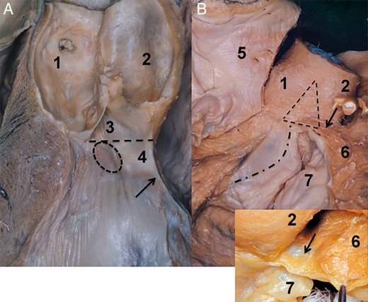 Topography of the right-sided aortic root base. (A) Vertical view of the left ventricular outflow tract and the aortic root. Section plane is through the middle of the non-coronary sinus and the left intervalvular triangle. The arrow indicates the transition between the membranous and the muscular septum. The dashed line indicates the aortic root base; note also the transition between the membranous septum and the intervalvular triangle. The dashed circle shows the position of the left main branch of the heart conduction system. From the topography, it becomes clear: in the large membranous septum the transition area of the LMB is far from the nadir of the right coronary sinus. The opposite is true in the small membranous septum. (B) Relation of the right intervalvular triangle and of the right ventricle. In the large image, the right atrium was removed. The interatrial septum is seen from the right side; it is positioned behind the non-coronary sinus. The aortic root, right intervalvular triangle and the right ventricle are seen from the superior right view. The dashed triangle indicates the right intervalvular triangle. The curved dash-pointed line corresponds to the attachment of the septal leaflet. This is inferior to the right intervalvular triangle base. The arrow indicates the right ventricular muscle being conjoined to the aortic root at the level of the right intervalvular triangle and the right coronary sinus. The inset shows the membranous structure of the right ventricle that is conjoined to the mentioned aortic root area. Note that deeply positioned sutures may easily damage this membranous element. 1. Non-coronary sinus, 2. Right coronary sinus, 3. Right intervalvular triangle, 4. Membranous septum, 5. Right atrium, 6. Right ventricle and 7. Tricuspid valve.