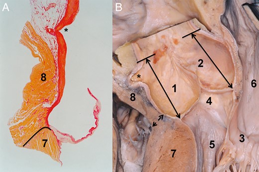 Relationship between the right coronary sinus and the right ventricle. (A) Histological specimen of the right coronary sinus and the right ventricular outflow tract. The staining of the specimen was with haematoxylin–eosin. The connective tissue, the white area between the aortic root and the right ventricular muscle, may be followed just to the level of the valve attachment. The border between the right ventricular muscle and the left ventricle is indicated by a solid line. The asterisk marks the opening of the right coronary artery. (B) Dry dissected specimen showing the relation between the right coronary sinus and the right ventricular outflow tract. The double arrow marks the border between the right ventricle and the left ventricular muscle. The double arrows positioned in the non- and the right coronary sinus serve to demonstrate the distance from the aortic root base to the sinotubular junction. Note that the distance in both sinuses is almost similar. In this specimen, the fact that the right ventricle is not attached to but rather conjoined to the aortic root is well demonstrated. The asterisk marks the opening of the right coronary artery. 1. Right coronary sinus, 2. Non-coronary sinus, 3. Mitral valve, 4. Membranous septum, 5. Left ventricular outflow tract, 6. Left atrium, 7. Left ventricle and 8. Right ventricle.