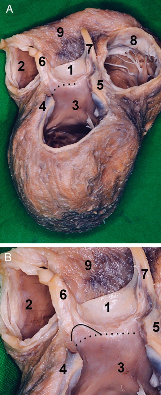 Morphology of the left aortic root base. (A) Dry dissected specimen of the heart after the removal of the mitral valve, left atrium, right atrium and sinuses of Valsalva. The specimen is seen from the superior posterior view. The left aortic root base is positioned between the nadir of the right coronary sinus and the nadir of the left coronary sinus. The aortic root base is at this level is of muscular structure. The muscle corresponds to the left ventricular outflow tract. The aortic root base is indicated by the pointed line. (B) The inferior one-third of the left intervalvular triangle is of left ventricular muscle. The superior two-thirds is of fibrous tissue. The border between the two elements is marked by a solid line. The aortic root base is marked by a pointed line. 1. Right coronary sinus, 2. Right ventricular outflow tract, 3. Left ventricular outflow tract, 4. Left fibrous trigonum, 5. Right fibrous trigonum, 6. Left intervalvular triangle, 7. Right intervalvular triangle, 8. Tricuspid valve and 9. Right ventricle.