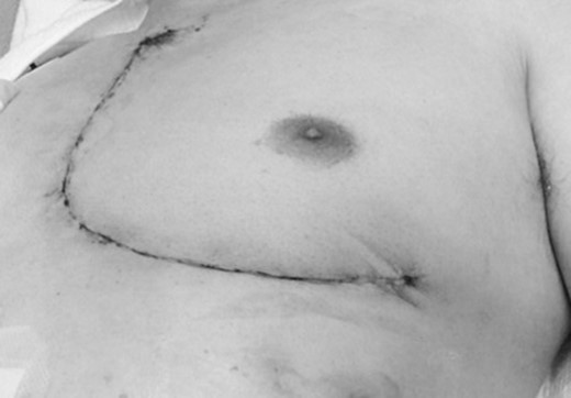 An L-incision made by a combination of left anterior thoracotomy and upper median sternotomy.