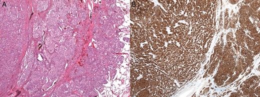 (A and B) Histopathological findings. On microscopic examination, the tumour cells are arranged in an alveolar pattern and are immune-positive for synaptophysin.