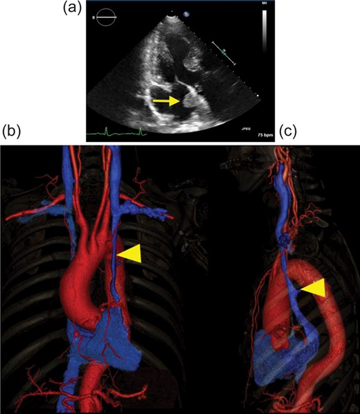 (a) Preoperative echocardiograph in three-chamber view. Arrow shows the cardiac tumour in the left atrium. (b and c) 3D vascular image of preoperative CT scan: (b) front view and (c) left lateral view. The red vessel shows the artery, and the blue vessel shows the vein. Arrow head points to the PLSVC. There was no major communication between the left and the right SVCs. CT: computed tomographic; PLSVC: persistent left superior vena cava.