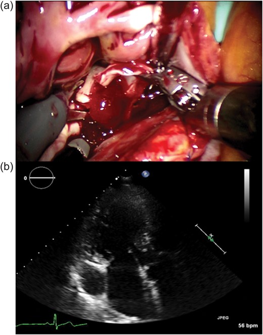 (a) Intraoperative image. Robotic tumour resection was performed by da Vinci. The arrow shows the tumour, which was found to be 20 mm in diameter, and was resected with its attachment to the atrial septum. (b) Preoperative echocardiograph in three-chamber view. There is no recurrence of the cardiac tumour.