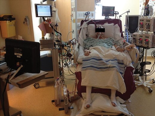 Patient requiring VV ECLS due to severe hypoxia after PEA. The use of a dual lumen VV ECLS allowed extubation and mobilization of the patient during recovery on ECLS. ECLS: extracorporeal life support; PEA: pulmonary endarterectomy; VV: veno-venous.