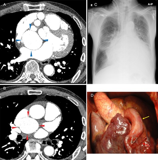 (A and B) Contrast-enhanced CT revealed two large masses. (A) Proximal aneurysm: dorsal to the right atrium and ventral to the left atrium, shown by blue arrows. (B) Distal aneurysm: dorsal to the superior vena cava and cranial to the right pulmonary artery, shown by red arrows. The abnormal vascular connections are not clearly understood because of the vessel tortuosity. (C) Preoperative chest X-ray showed a cardiothoracic ratio of 76%. (D) Intraoperative findings through median sternotomy. The dilated proximal right coronary artery and the right ventricle branch are shown by the yellow and red arrows, respectively.