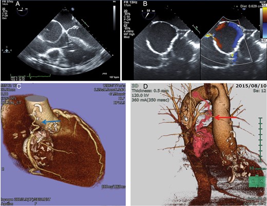 (A and B) Preoperative transoesophageal echocardiography showed a large mass of 60 × 50 mm in the interatrial space with a fistula to the right atrium. The size of the fistula was 6.3 mm. (C) Postoperative three-dimensional CT coronary angiography showed patent aortocoronary bypass of the radial artery conduit, shown by blue arrow. (D) Postoperative three-dimensional CT angiography demonstrated a residual abnormal vascular connection to the distal aneurysm from the bronchial artery, shown by red arrow.